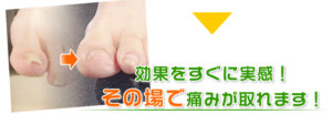 横須賀市北久里浜の鍼灸整骨院ひまわり　巻き爪矯正の写真