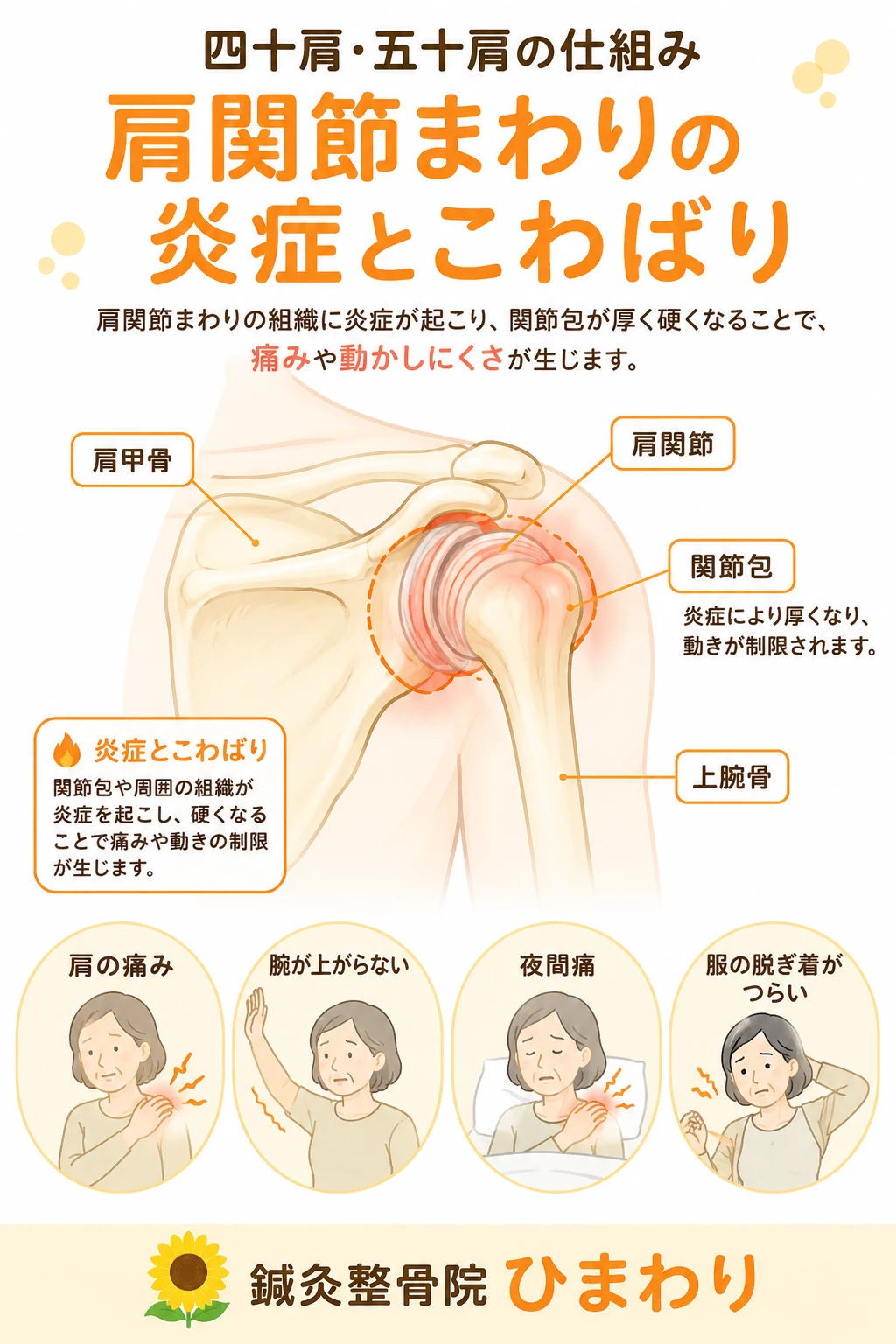 四十肩五十肩で肩関節まわりの炎症やこわばりにより肩の痛みや腕が上がらない症状が起こる仕組みを説明する図解画像
