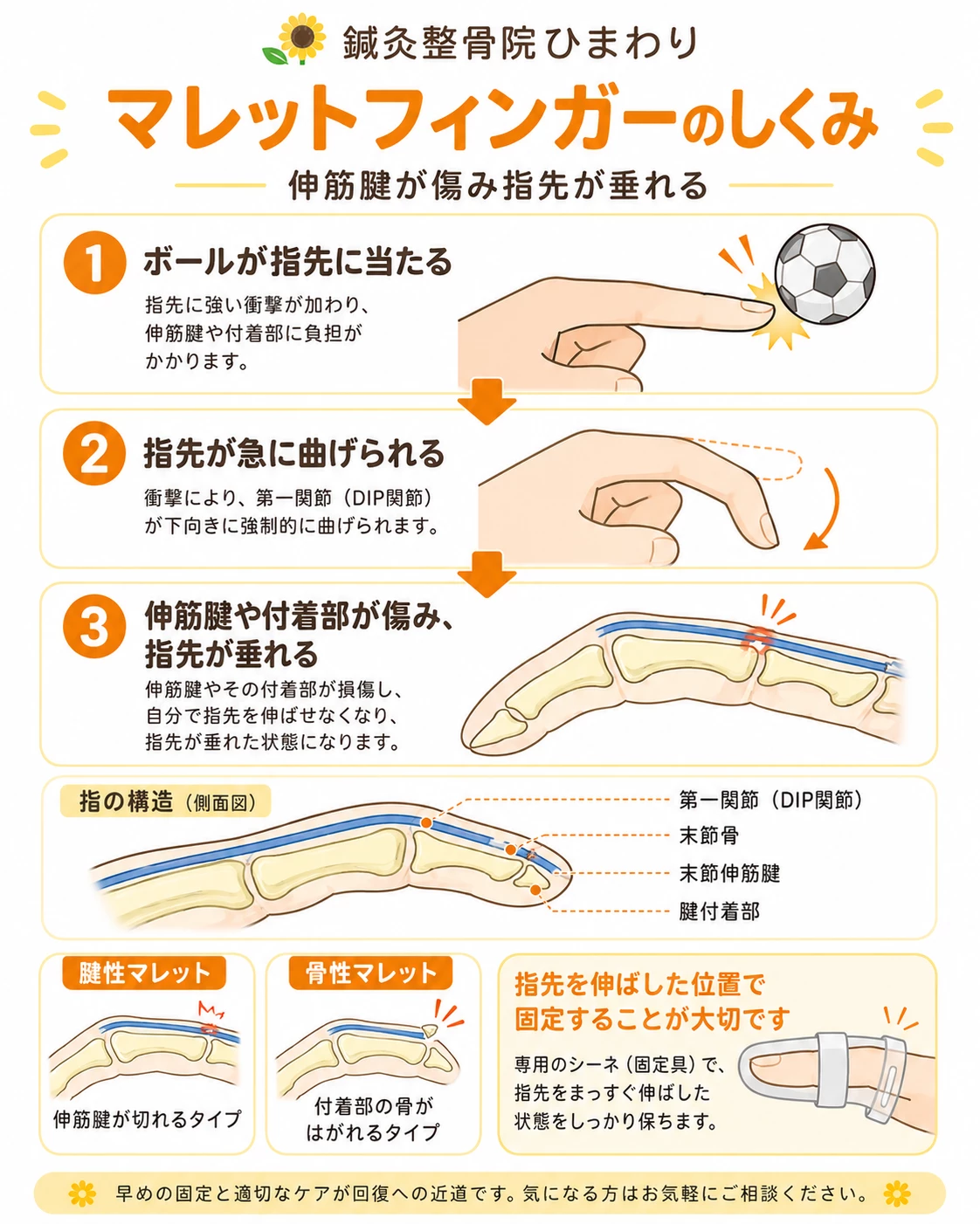 マレットフィンガーで末節伸筋腱や腱の付着部が損傷し、指先の第一関節が曲がったまま伸びにくくなる仕組みを示した図解