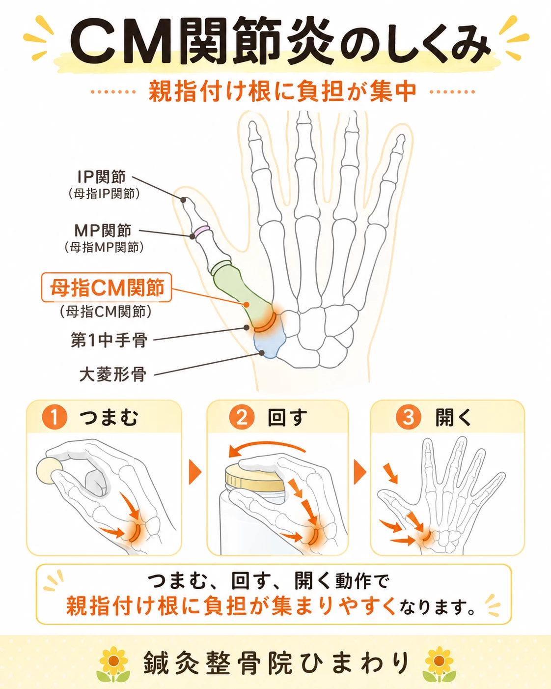 母指CM関節で親指付け根に負担が集中し、つまむ、回す、開く動作で痛みが出る仕組みを示した図解