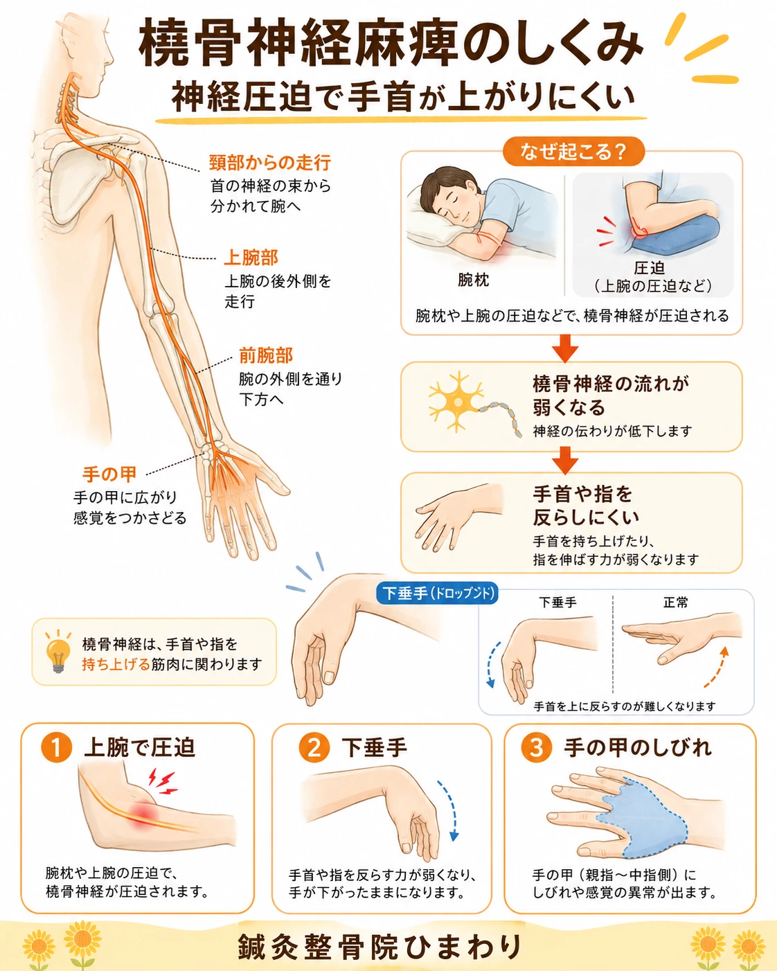 橈骨神経が上腕から前腕、手の甲へ走行し、圧迫されることで手首や指を反らしにくくなる仕組みを示した図解
