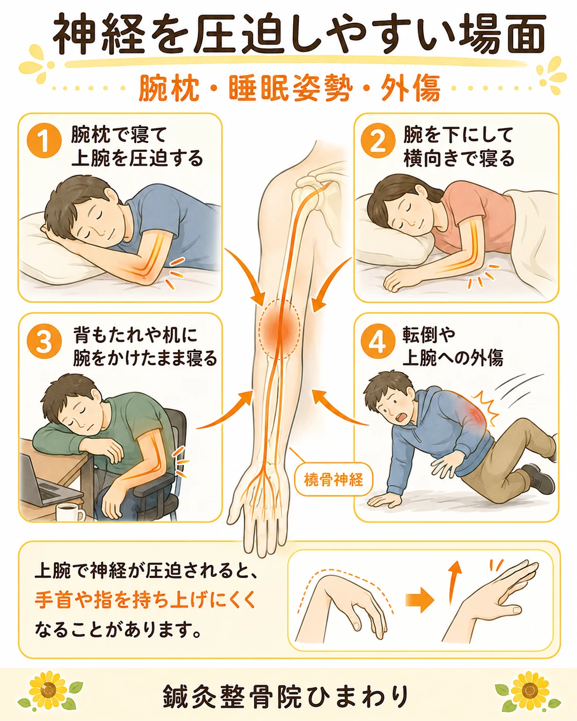 腕枕、腕を下にして寝る姿勢、椅子にもたれて腕を圧迫する姿勢、外傷によって橈骨神経に負担がかかることを示した画像