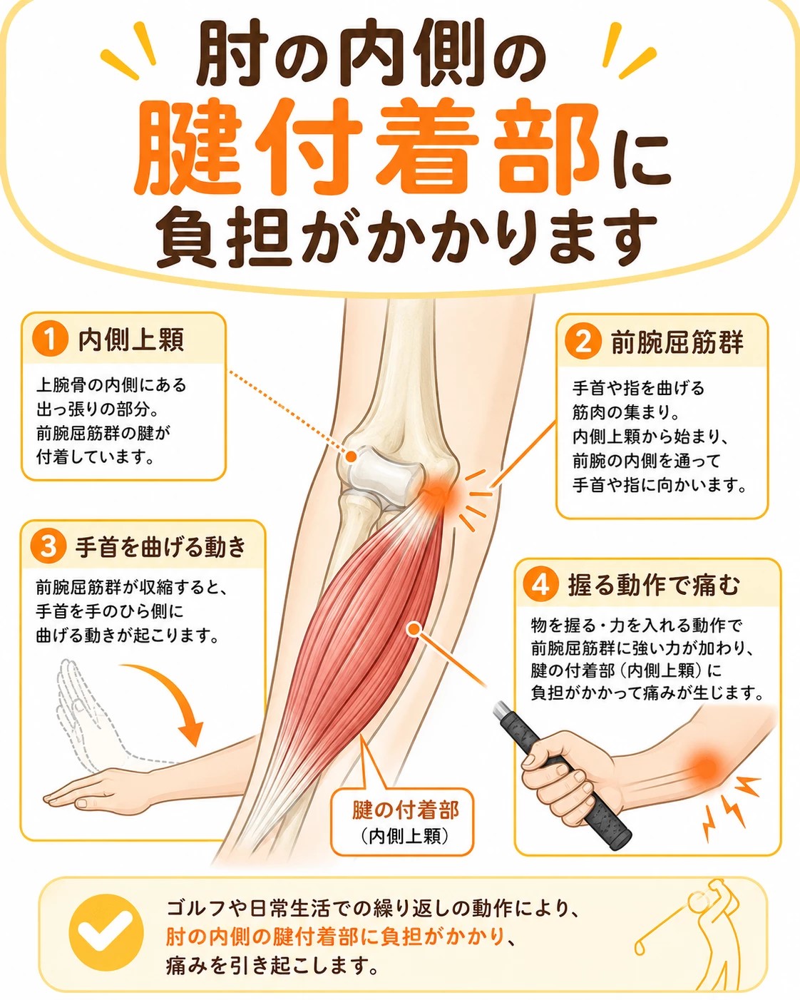 内側上顆炎ゴルフ肘で前腕屈筋群の腱付着部に負担がかかり肘の内側に痛みが出る仕組みを説明する図解画像