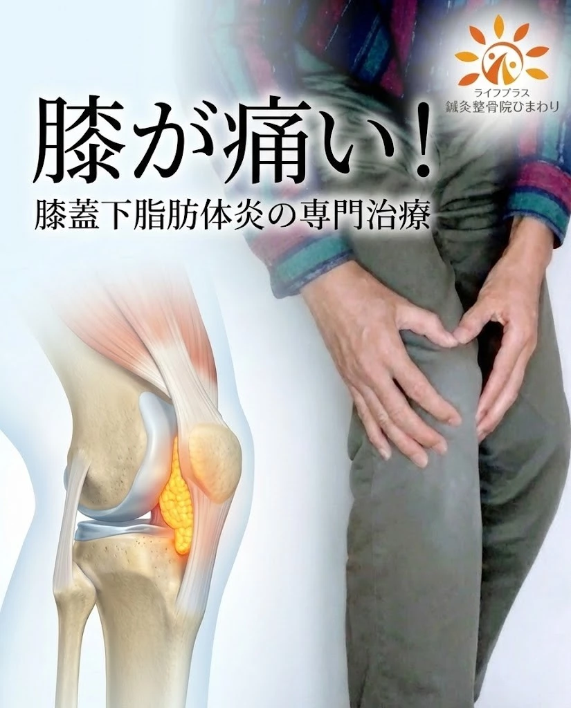 横須賀市 膝蓋下脂肪体炎の施術|鍼灸整骨院ひまわり北久里浜院 横須賀市の鍼灸整骨院ひまわり北久里浜院 膝が痛い方へ 膝蓋下脂肪体炎の専門施術イメージ