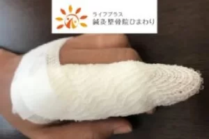 横須賀市の鍼灸整骨院ひまわり(北久里浜院・衣笠院)で行うマレットフィンガー(突き指)の固定施術。指に包帯とシーネ(固定具)を巻いている様子。