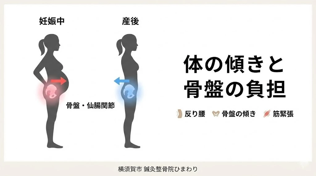 横須賀市 妊娠中 産後の腰痛 骨盤と仙腸関節の負担イメージ 図解
