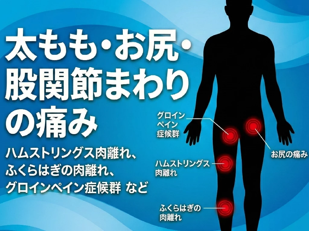 太ももお尻股関節まわりの痛みとハムストリングス肉離れやグロインペイン症候群を示すスポーツ障害イラスト