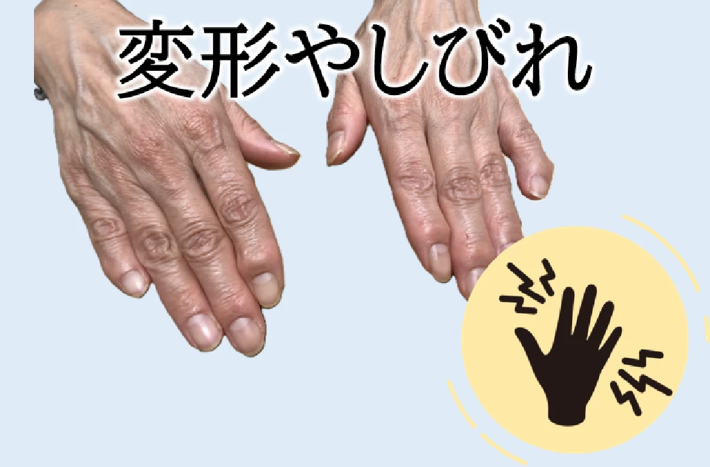 手指の変形としびれの症状をイメージした写真