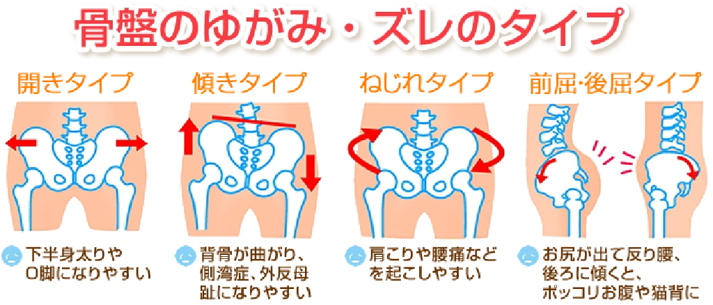 横須賀市ひまわりの骨盤のゆがみ・ズレのタイプ解説イラスト 開きタイプ傾きタイプねじれタイプ前屈後屈タイプなど四つの骨盤のゆがみパターンと起こりやすい症状を説明している横須賀市の鍼灸整骨院ひまわりの骨盤ゆがみ解説図