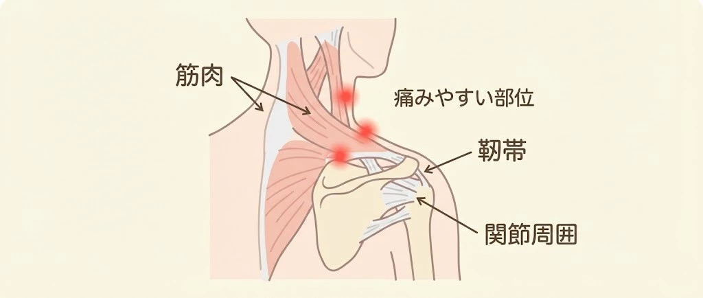 むちうちで首肩まわりの筋肉や靭帯、関節周囲に負担がかかるイメージ図